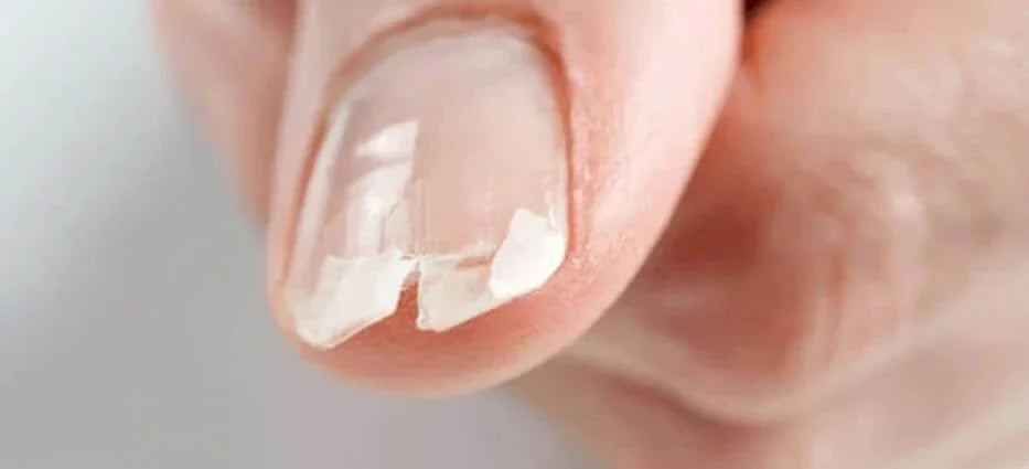 Nagelproblemen
